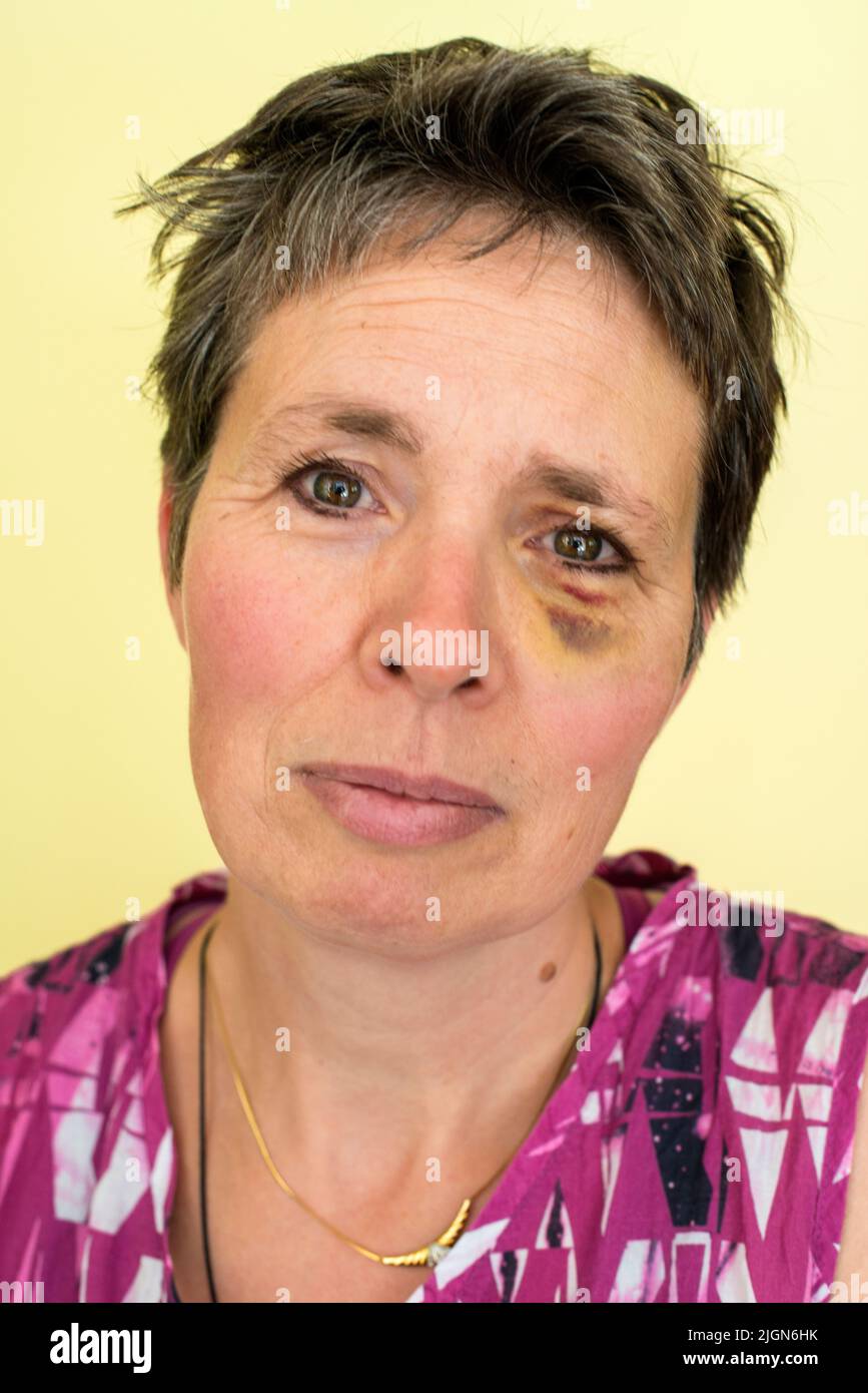 Tilburg, Netherlands. Mature adult woman, portrait, having a black eye after an accident on her bicycle. Stock Photo