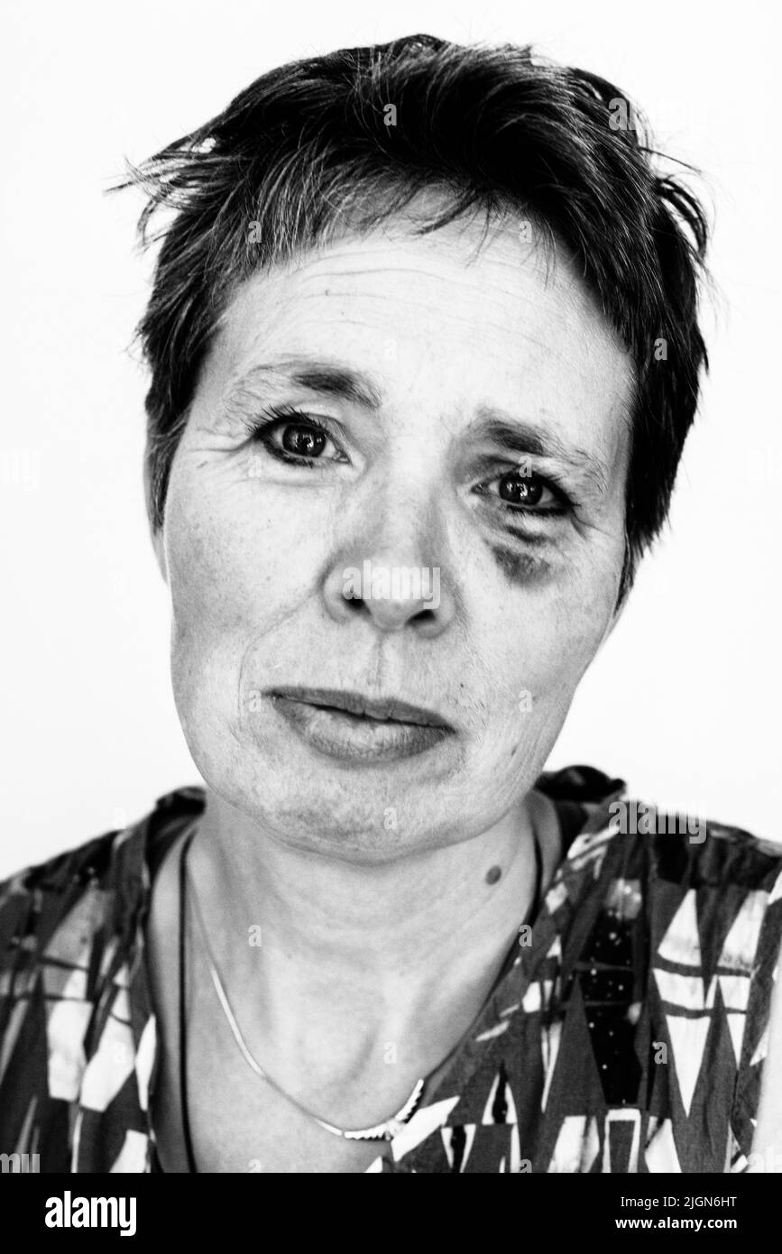 Tilburg, Netherlands. Mature adult woman, portrait, having a black eye after an accident on her bicycle. Stock Photo