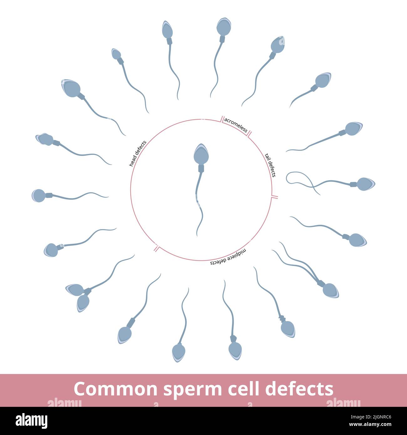 Common sperm cell defects. Visualization of common sperm cell defects, including head, tail, and midpiece pathologies, acromeless defect. Stock Vector