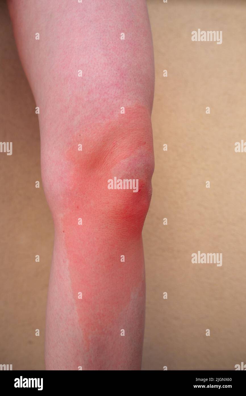 Close up of burn on leg Standing caucasian woman leg with first degree burn against wall in background Skin burn Red skin after burn closeup Stock Photo