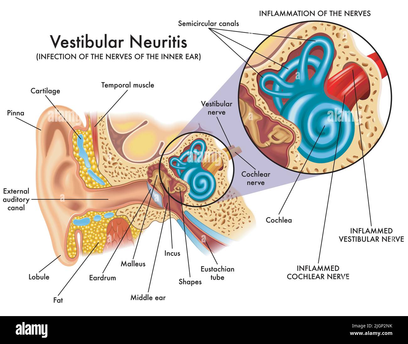 Medical illustration shows the infection and inflammation of the nerves of the inner ear, called vestibular neuritis, with annotations. Stock Vector