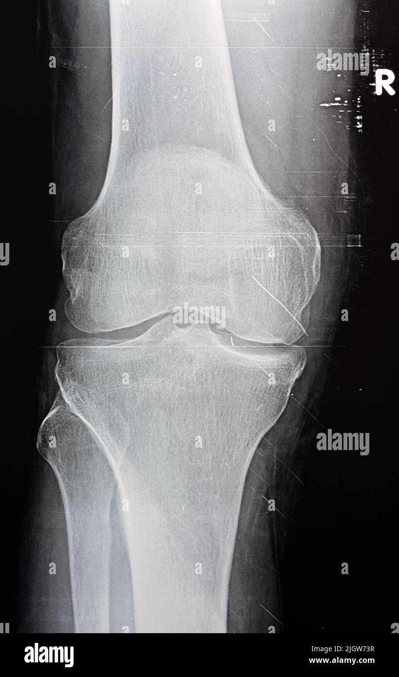 Plain X ray of the right knee shows apparent joint osteoarthritis according to Kellgren and Lawrence system for classification of osteoarthritis with Stock Photo