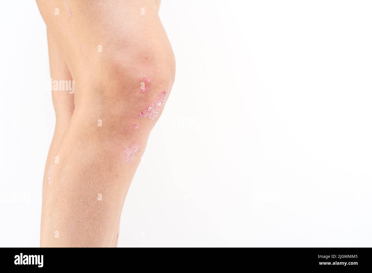 Swelling skin knee Cut Out Stock Images & Pictures Alamy