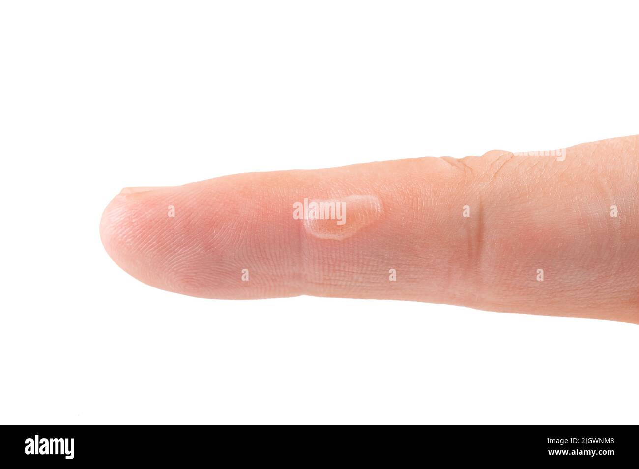 blister on finger skin, human body damage callus, health care theme