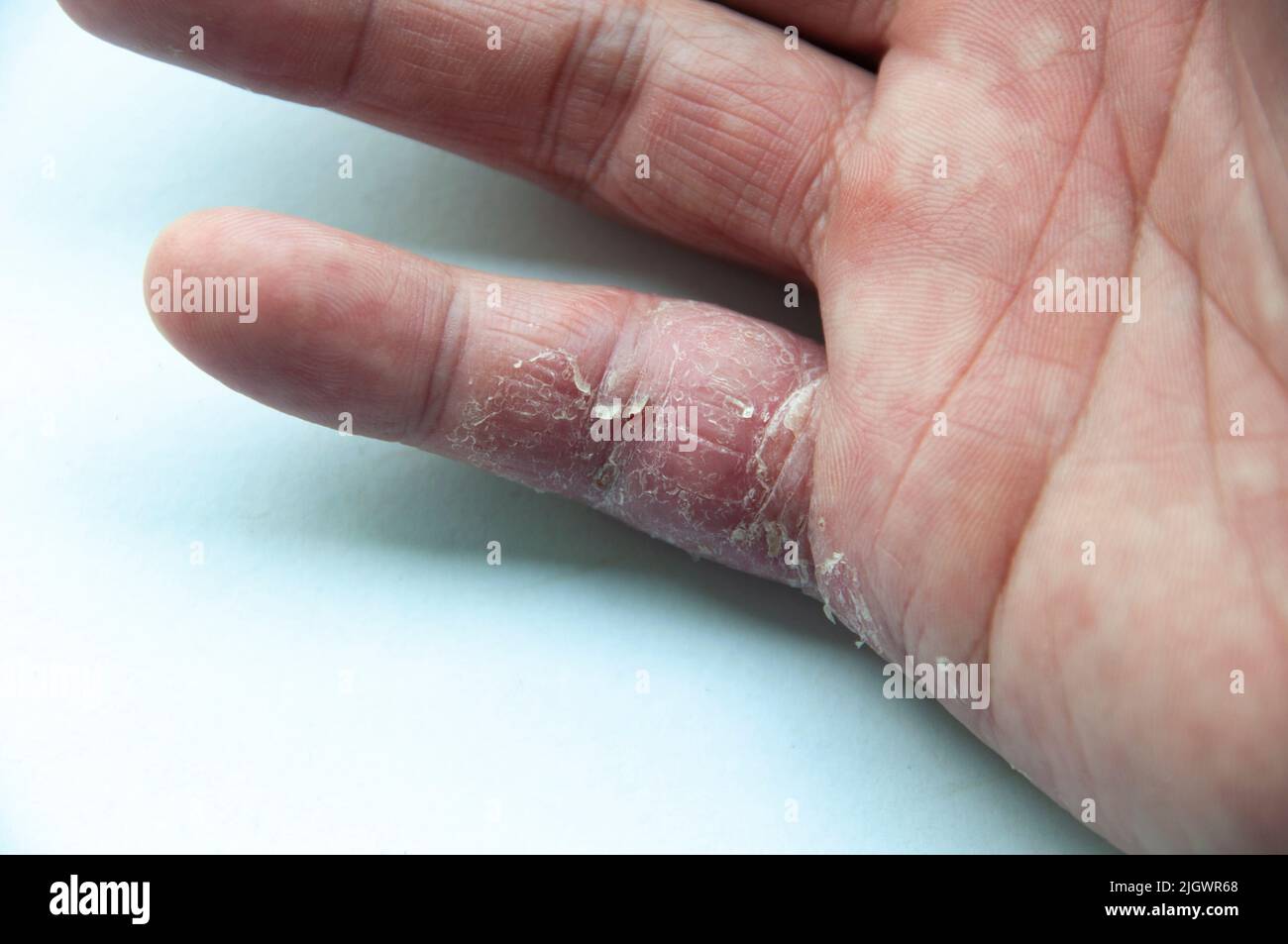 Skin disease for many people - eczema on hand and finger. White cover background. Stock Photo