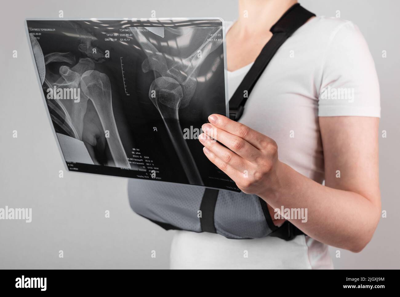 Woman wearing arm sling and looking at X-ray image. Female suffering from shoulder, clavicle, acromion fracture, strain. Health care, injury diagnostics concept. High quality photo Stock Photo