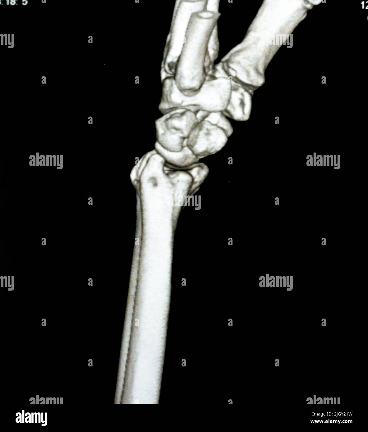 Fractured right wrist x ray hires stock photography and images Alamy