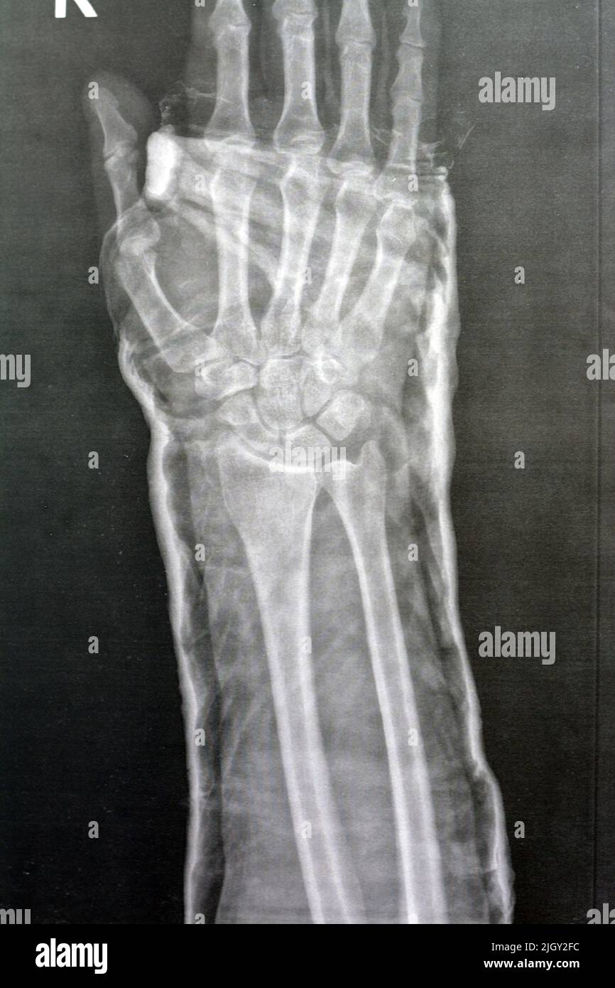 Plain x ray right wrist joint shows right distal radius fracture, closed reduction and cast done, selective focus of x-ray imaging showing fracture ra Stock Photo