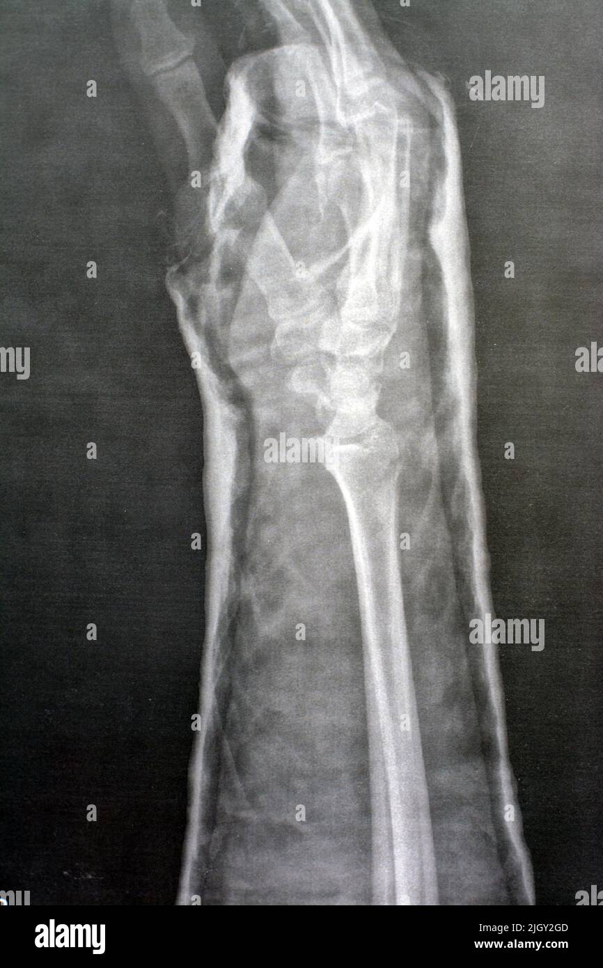 Plain x ray right wrist joint shows right distal radius fracture, closed reduction and cast done, selective focus of x-ray imaging showing fracture ra Stock Photo