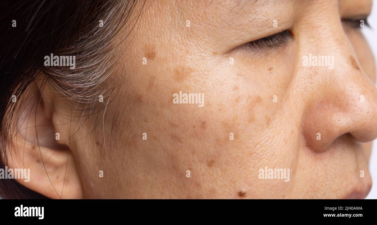 Menopausal women worry about melasma on face Stock Photo Alamy
