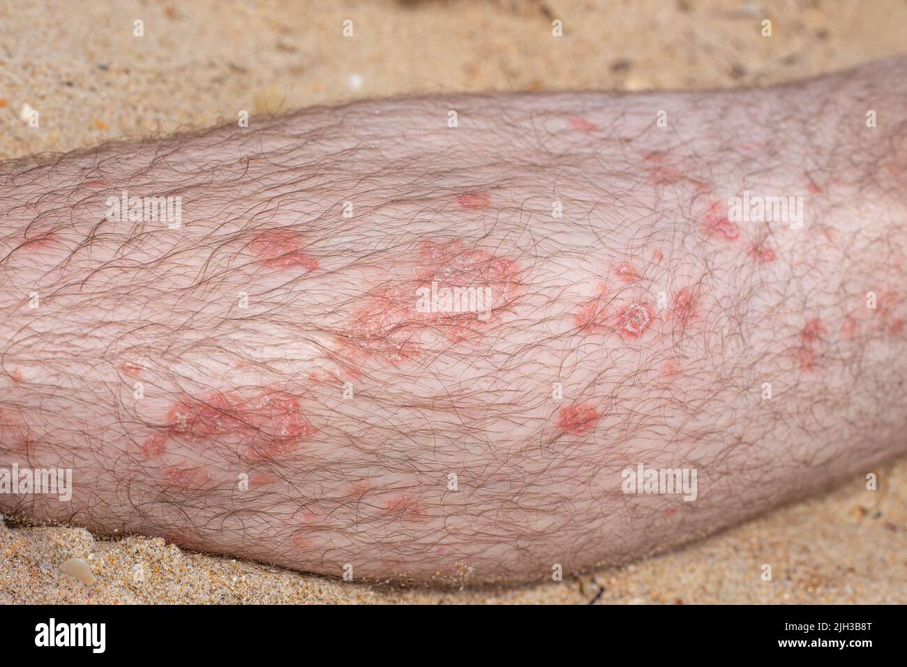 Part of a male leg with psoriatic plaques, covered with hair. Skin diseases in adults. Stock Photo