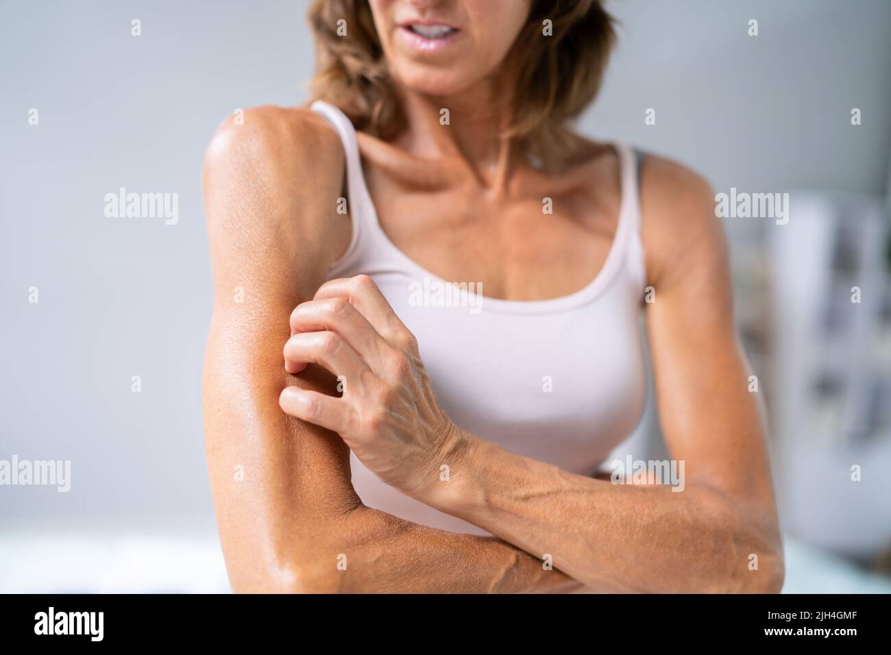 Woman With Itchy Skin. Allergy Or Psoriasis Stock Photo
