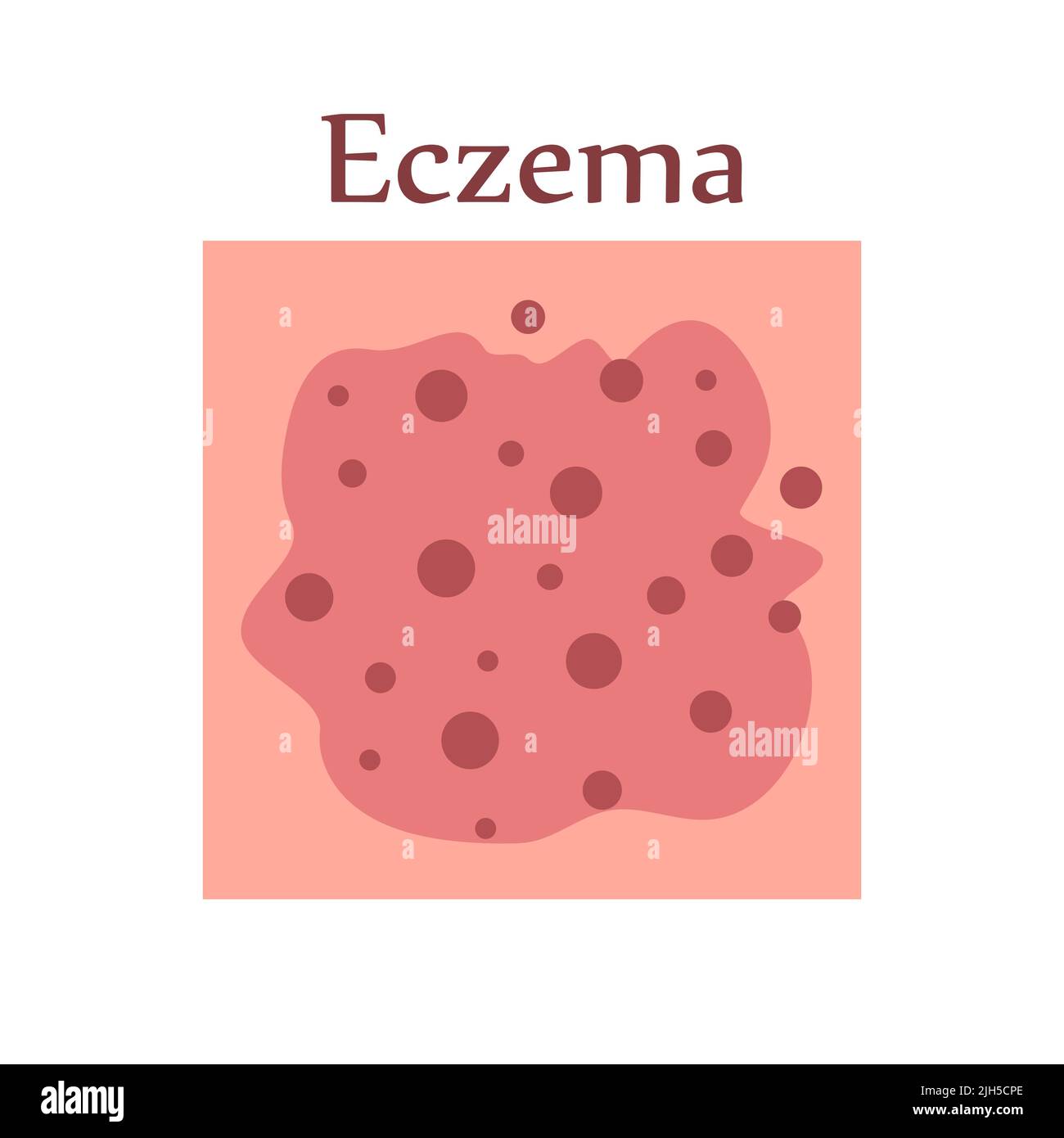 Eczema on human skin. Dermatological disease. The symptom is itching