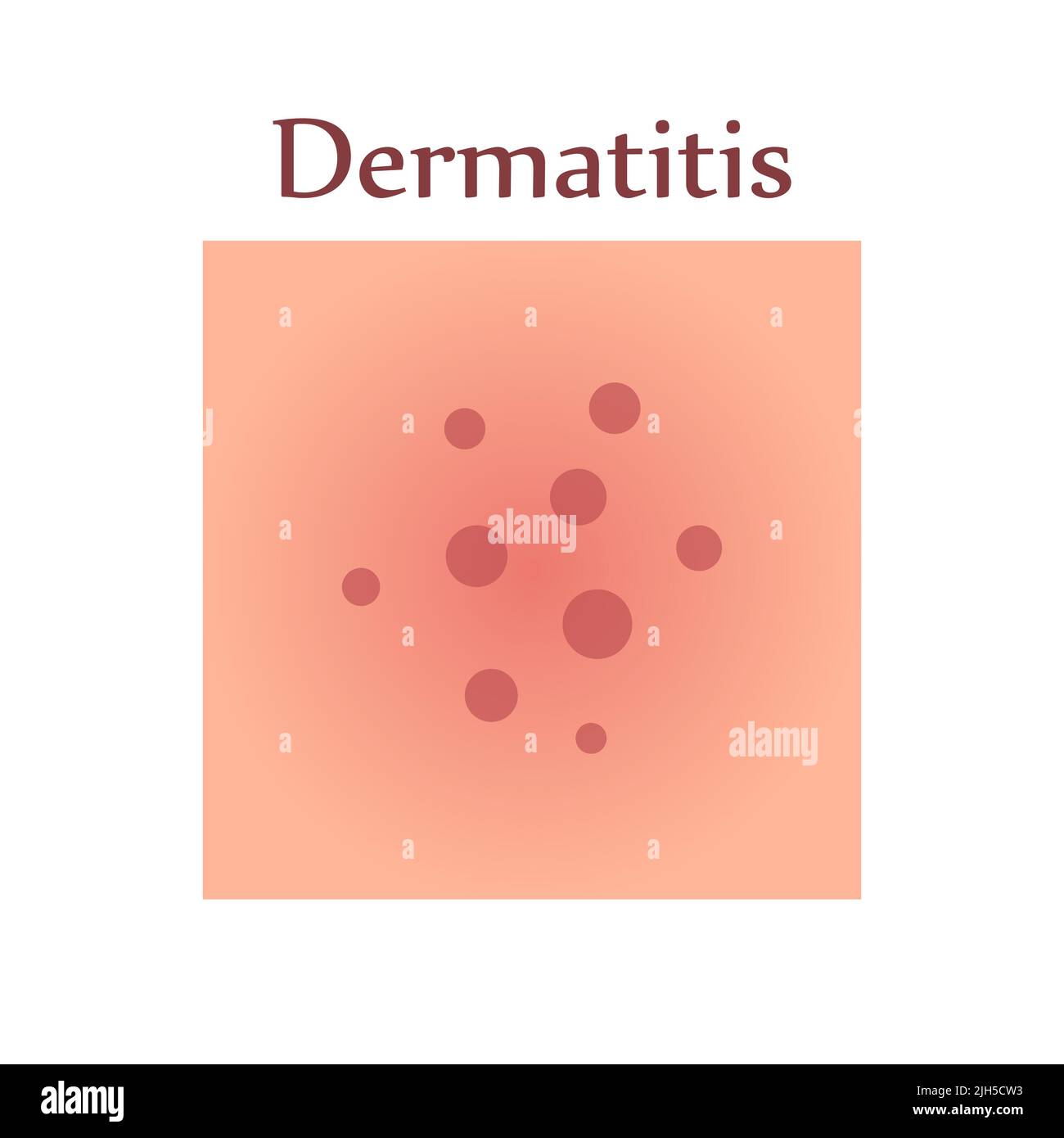 Dermatitis on human skin. Dermatological disease. The symptom is