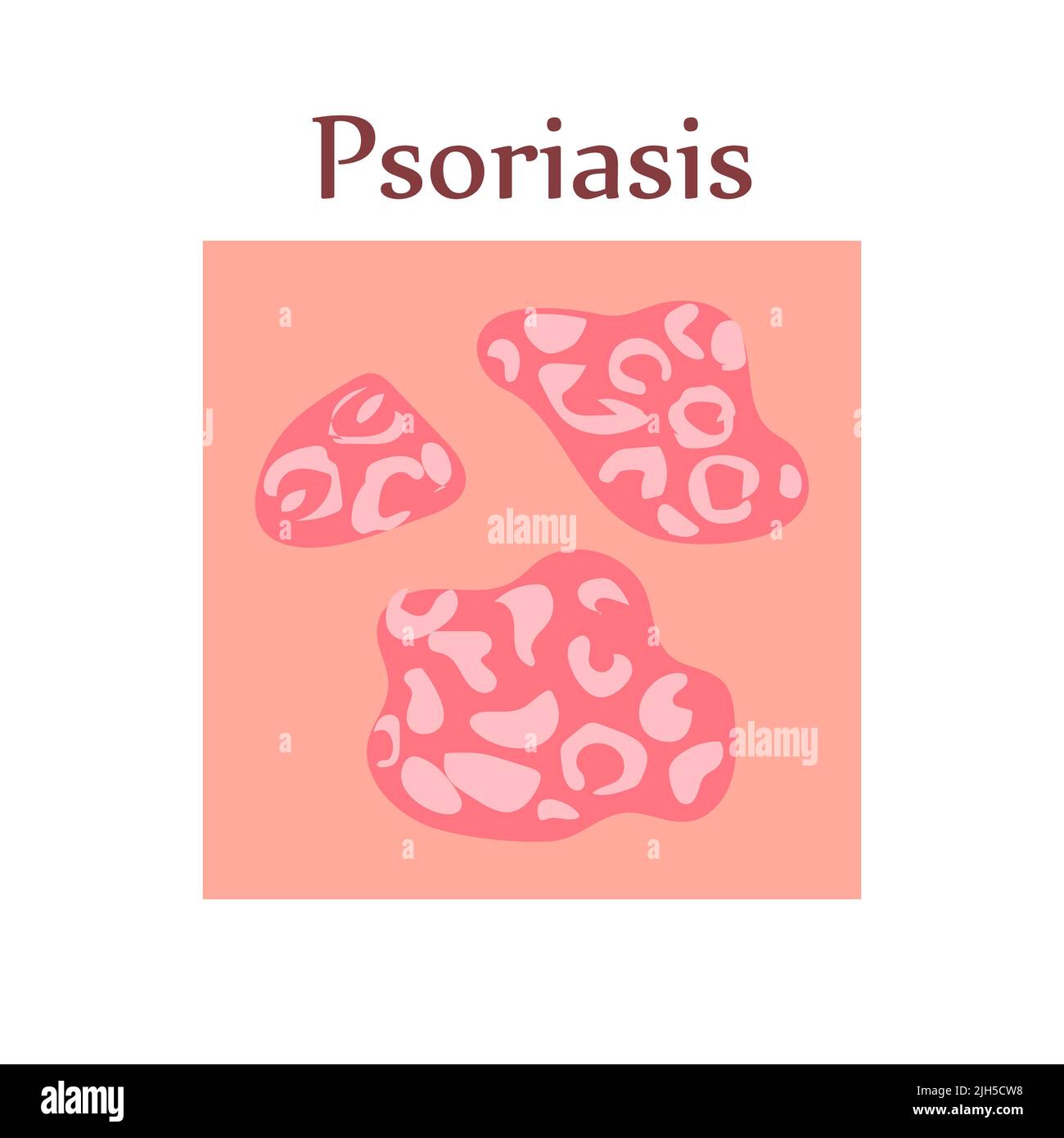 Psoriasis on human skin. Dermatological disease. The symptom is itching
