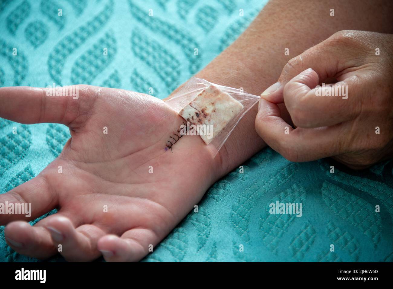 A female nurse removes a padded bandage on the wrist and hand of a woman. The palm has a number of black nylon stitches from carpal tunnel surgery. Stock Photo