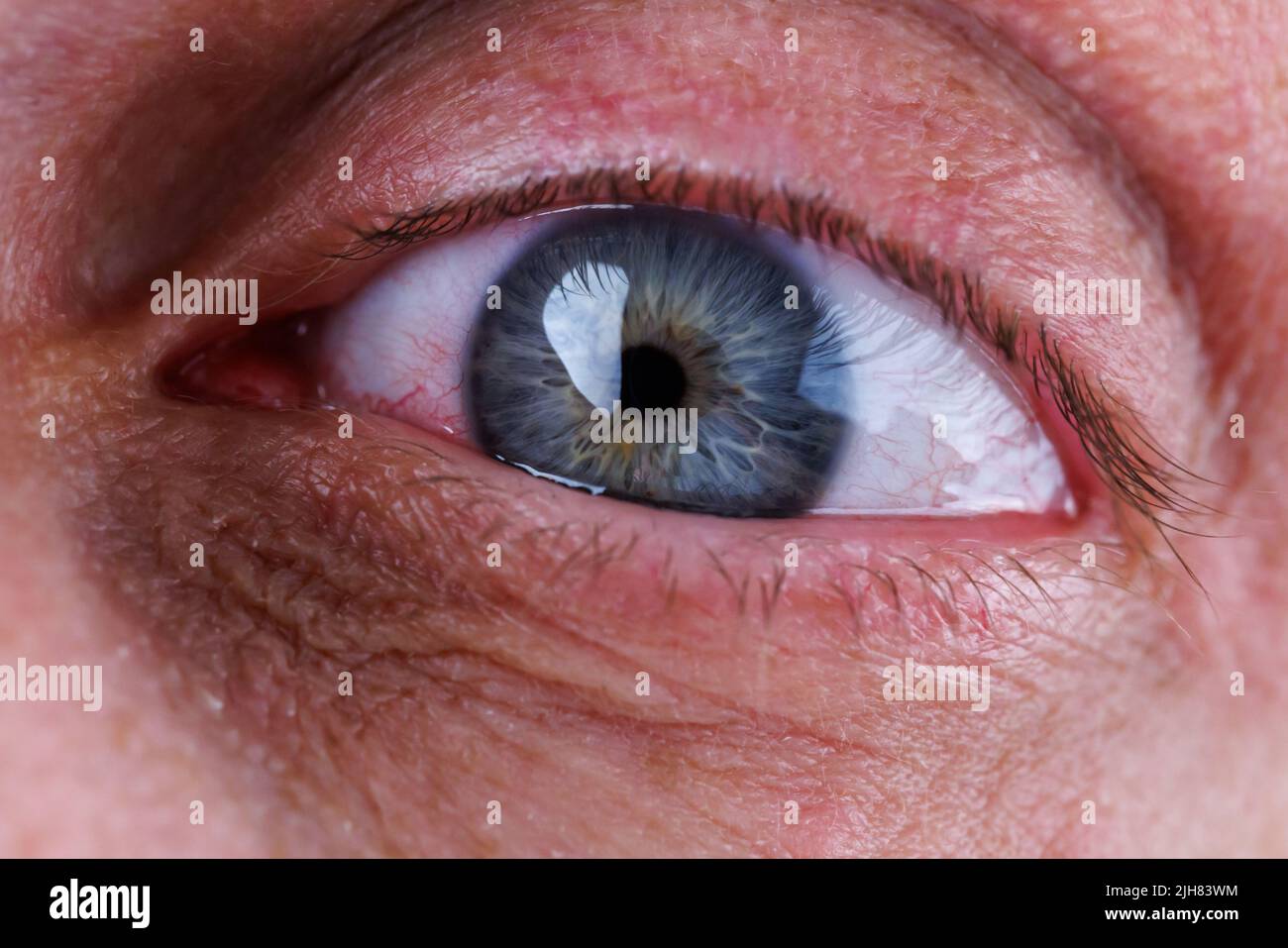 gray eye of caucasian male with red capillary mesh, closeup macro view