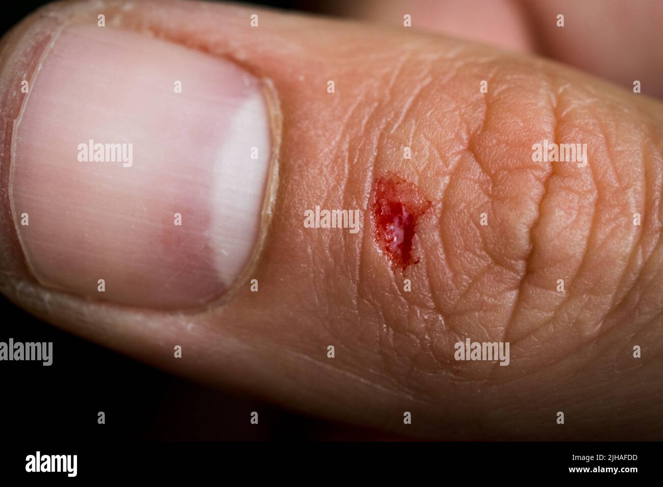 https://c8.alamy.com/comp/2JHAFDD/close-up-shot-of-a-small-and-deep-wound-on-a-thumb-2JHAFDD.jpg
