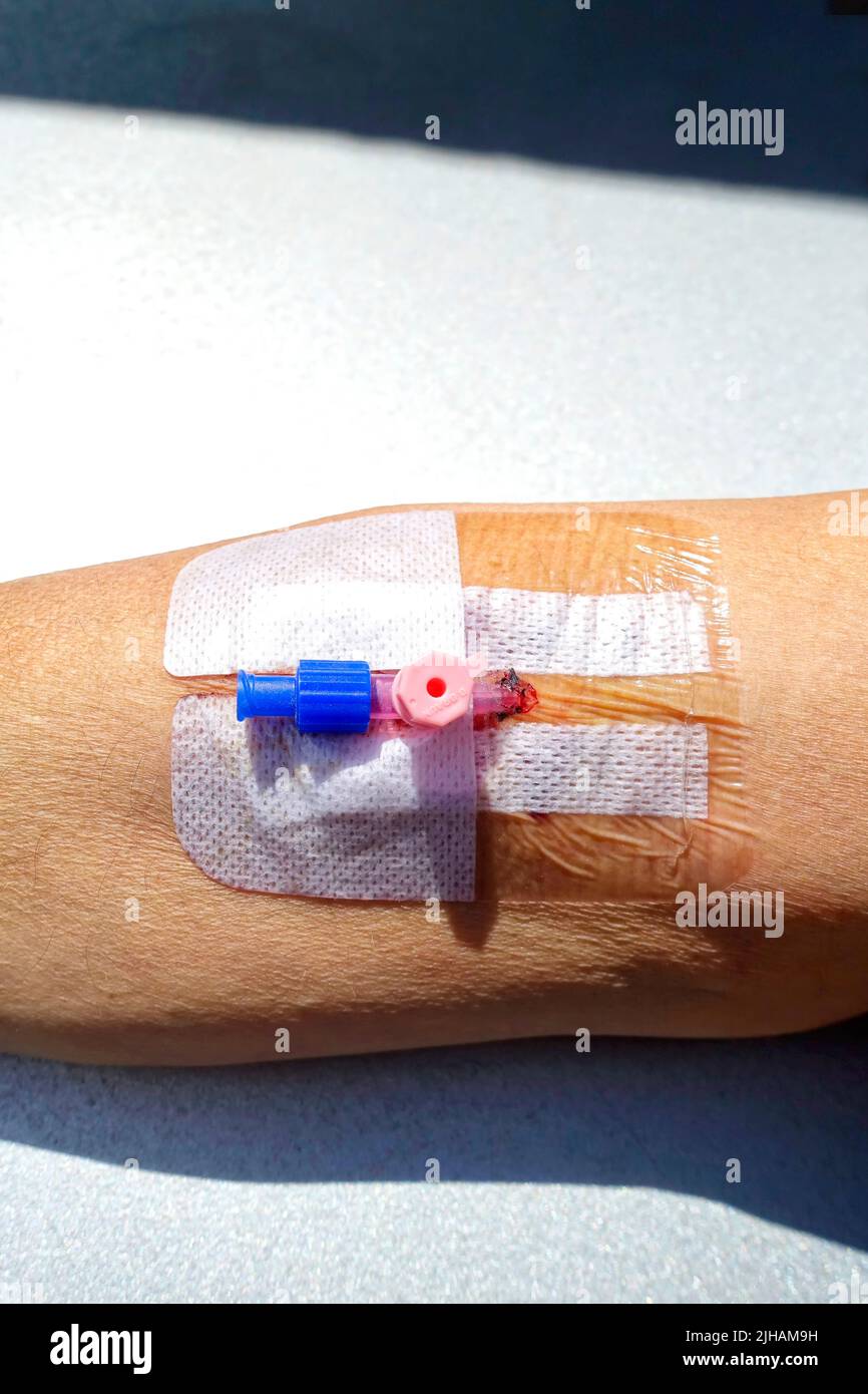 Peripheral venous catheter, Berlin, Germany Stock Photo Alamy