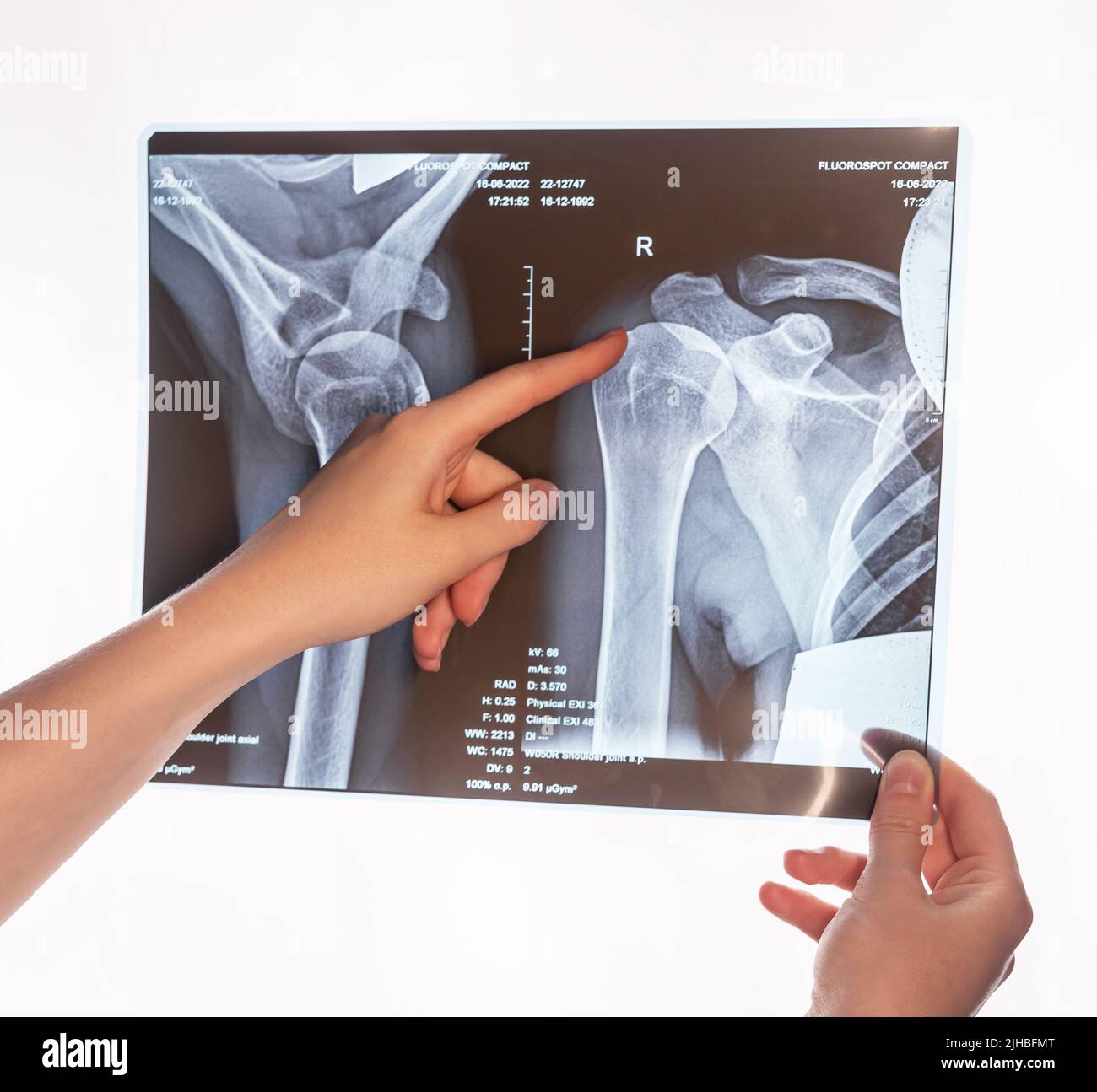 Forefinger pointing to trauma at shoulder, clavicle X-ray image. Acromion, acromial end fracture. Arm injury. Health care, medical examination concept. Broken bones detection. High quality photo Stock Photo