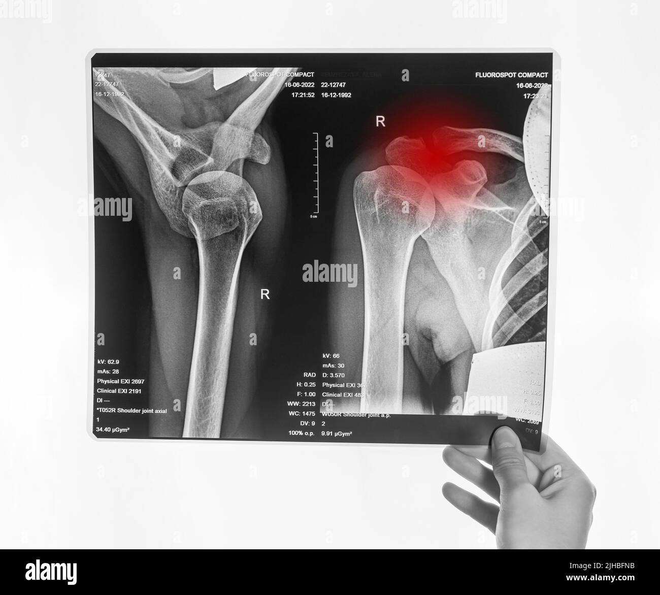 Hand holding shoulder, clavicle X-ray image with red point. Acromion, acromial end fracture. Arm injury. Health care, medical examination concept. Black and white. High quality photo Stock Photo