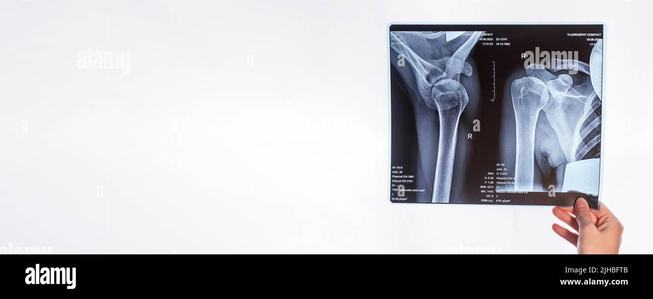 Banner with hand holding shoulder, clavicle X-ray image. Acromion, acromial end fracture. Health care, medical examination, arm injury detection concept. Copy space. High quality photo Stock Photo