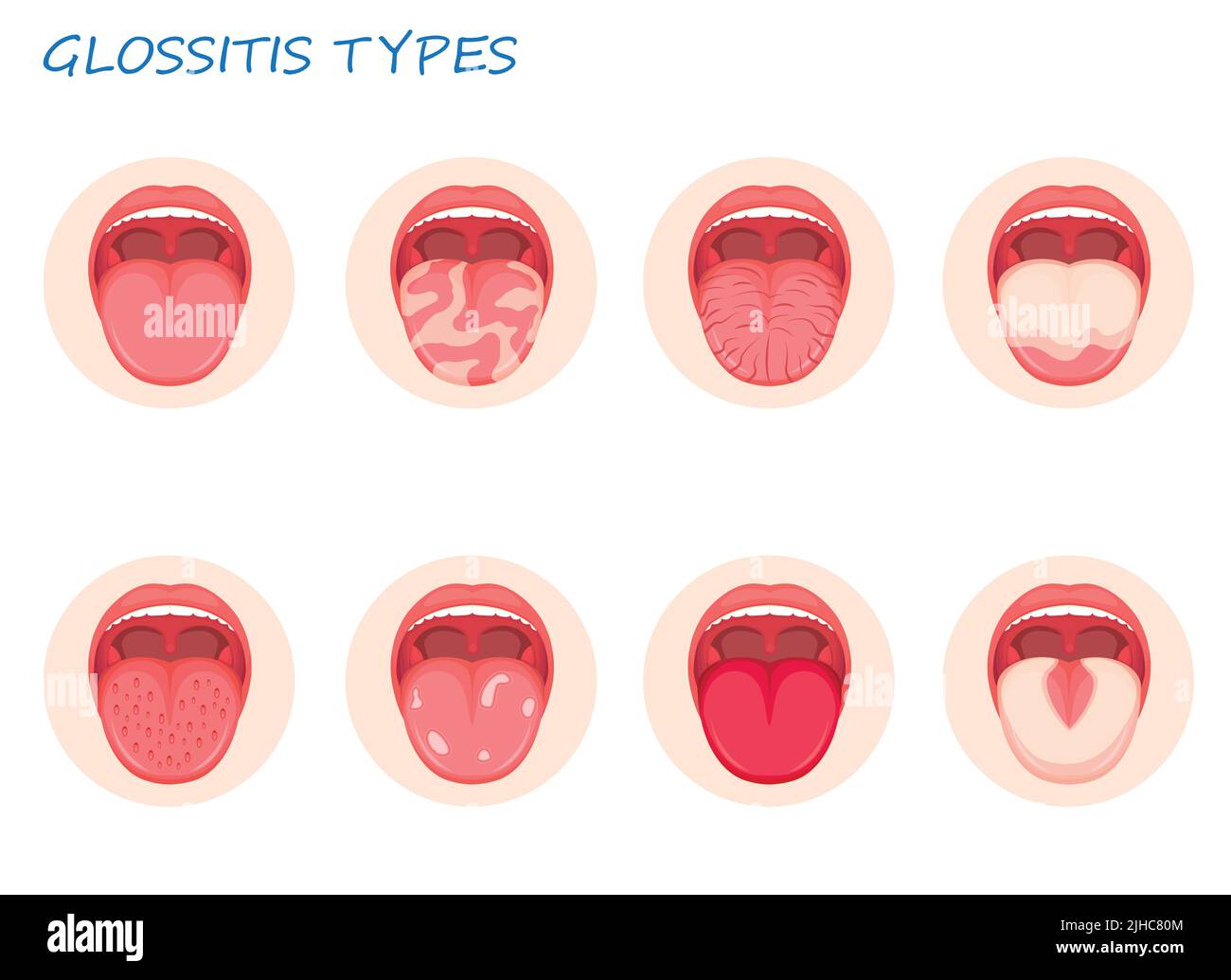 Types glossitis. Inflammatory disease tongue, vector illustration Stock Vector