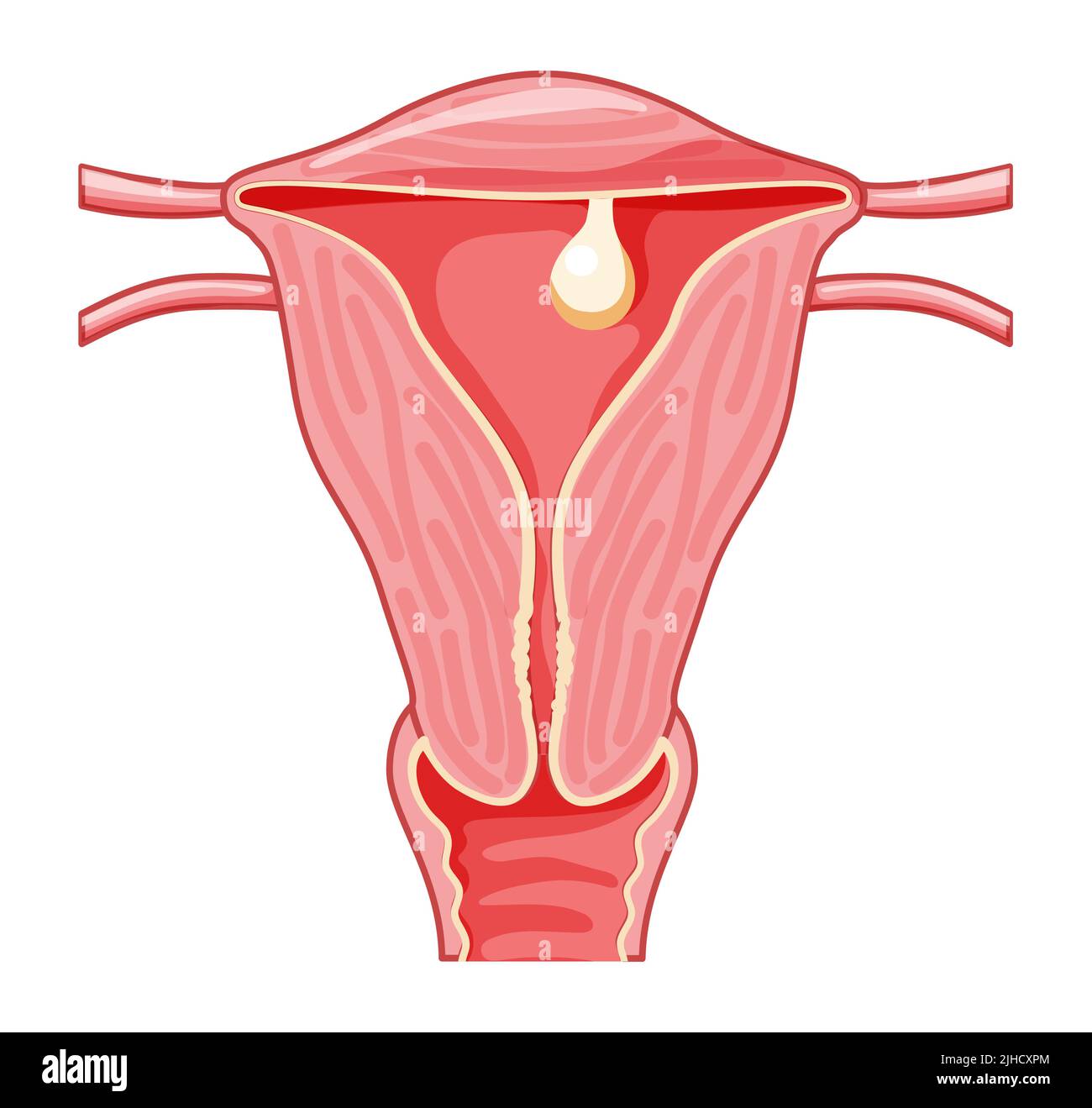 Pedunculated Polyp in the uterus Female reproductive system in cross ...
