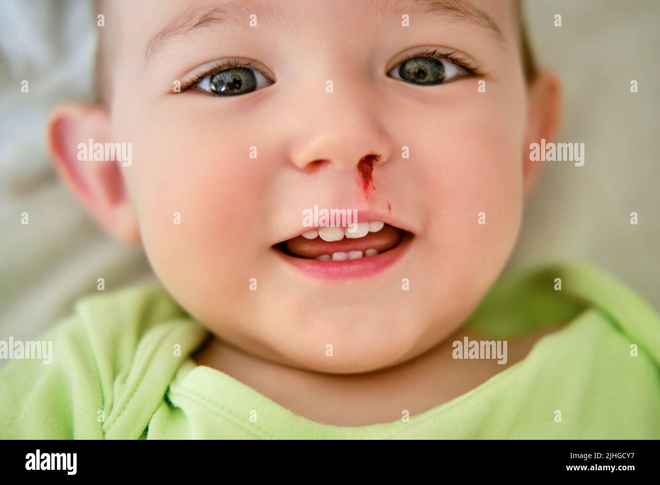 Happy toddler baby boy with a bloody nose. Bleeding from the nose of a