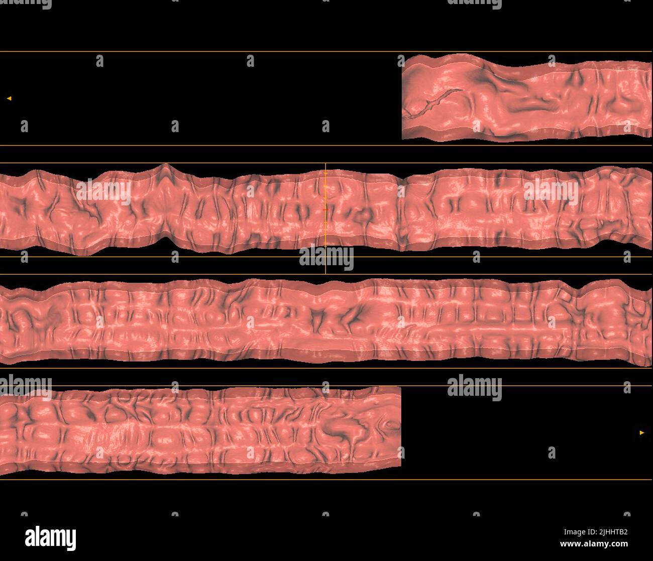 CT colonography or CT Scan of Colon rendering image on the screen for