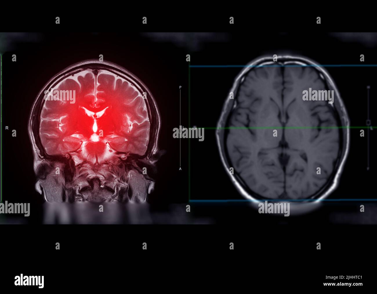 MRI  brain  Coronal T2W plane for detect stroke disease and Brain tumors and cysts. Stock Photo