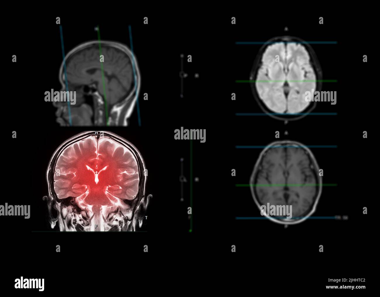 MRI  brain showing coronal plane of the brain  for detect stroke disease and Brain tumors and cysts. Stock Photo