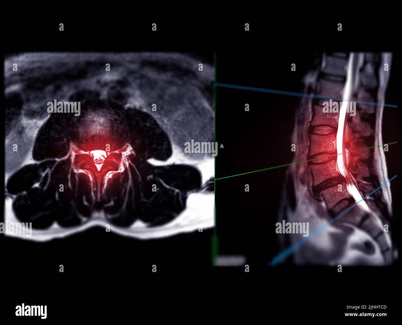 MRI L-S spine or lumbar spine Axial T2W view with sagittal plane for ...