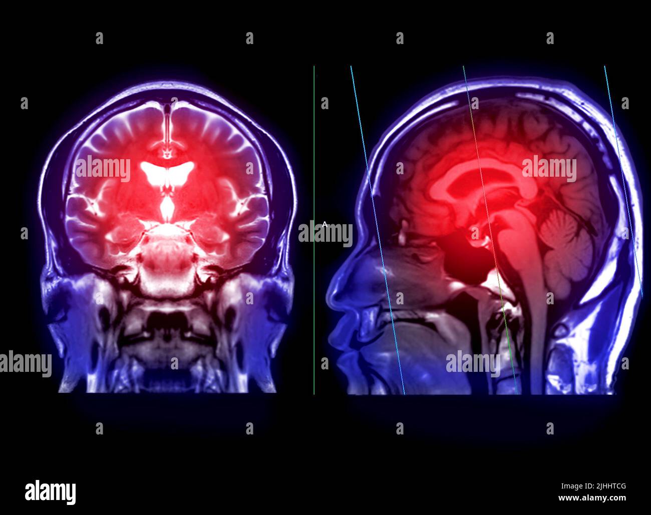 MRI brain for detect a variety of conditions of the brain such as cysts, tumors, bleeding and stroke diseases. Stock Photo