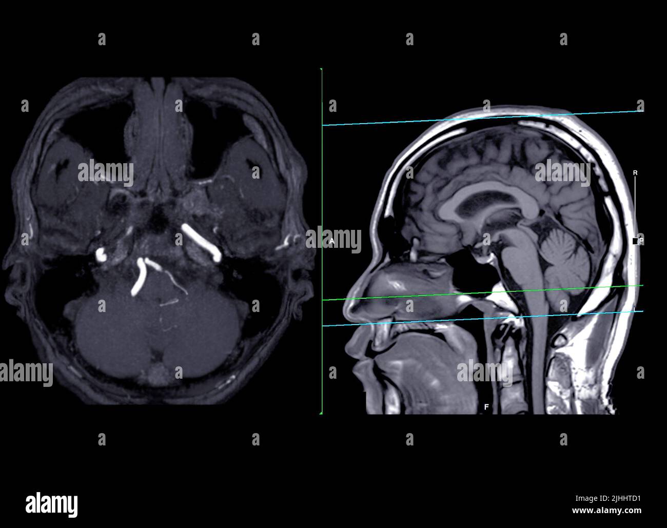 MRA Brain or Magnetic resonance angiography of the brain axial MIP and sagittal view showing cerebral artery . Stock Photo