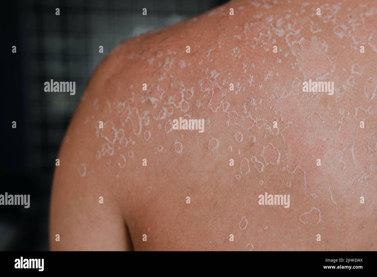 Dermatological conditions of peeling skin on man's back and shoulders, peeling skin and skin care concept. Close up Stock Photo