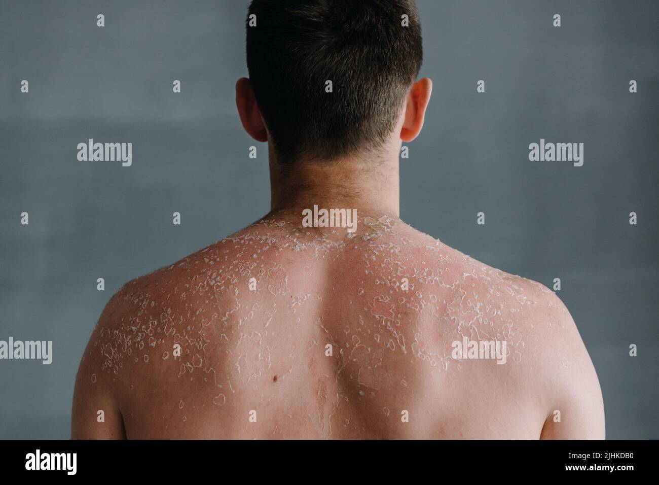 Dermatological conditions of peeling skin on man's back and shoulders, peeling skin and skin care concept Stock Photo