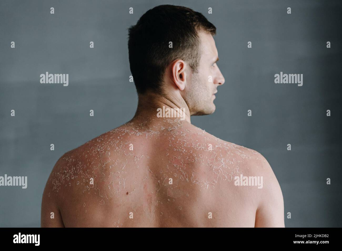 Dermatological conditions of peeling skin on man's back and shoulders Stock Photo