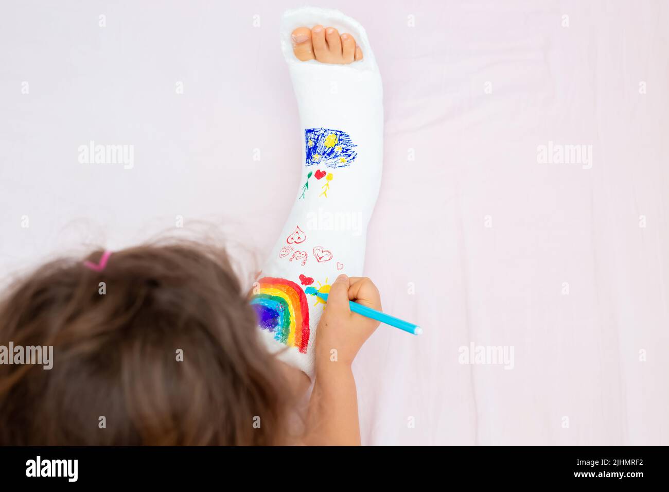 A unrecognizable little girl with a broken leg at home on the bed draws with felt-tip pens on an orthopedic cast . How to have fun with a broken leg Stock Photo