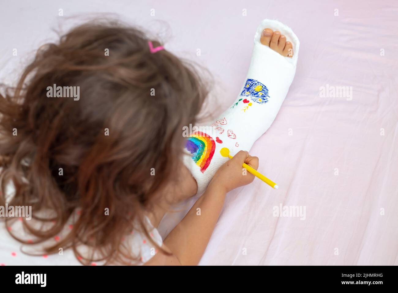 A unrecognizable little girl with a broken leg at home on the bed draws with felt-tip pens on an orthopedic cast . How to have fun with a broken leg Stock Photo
