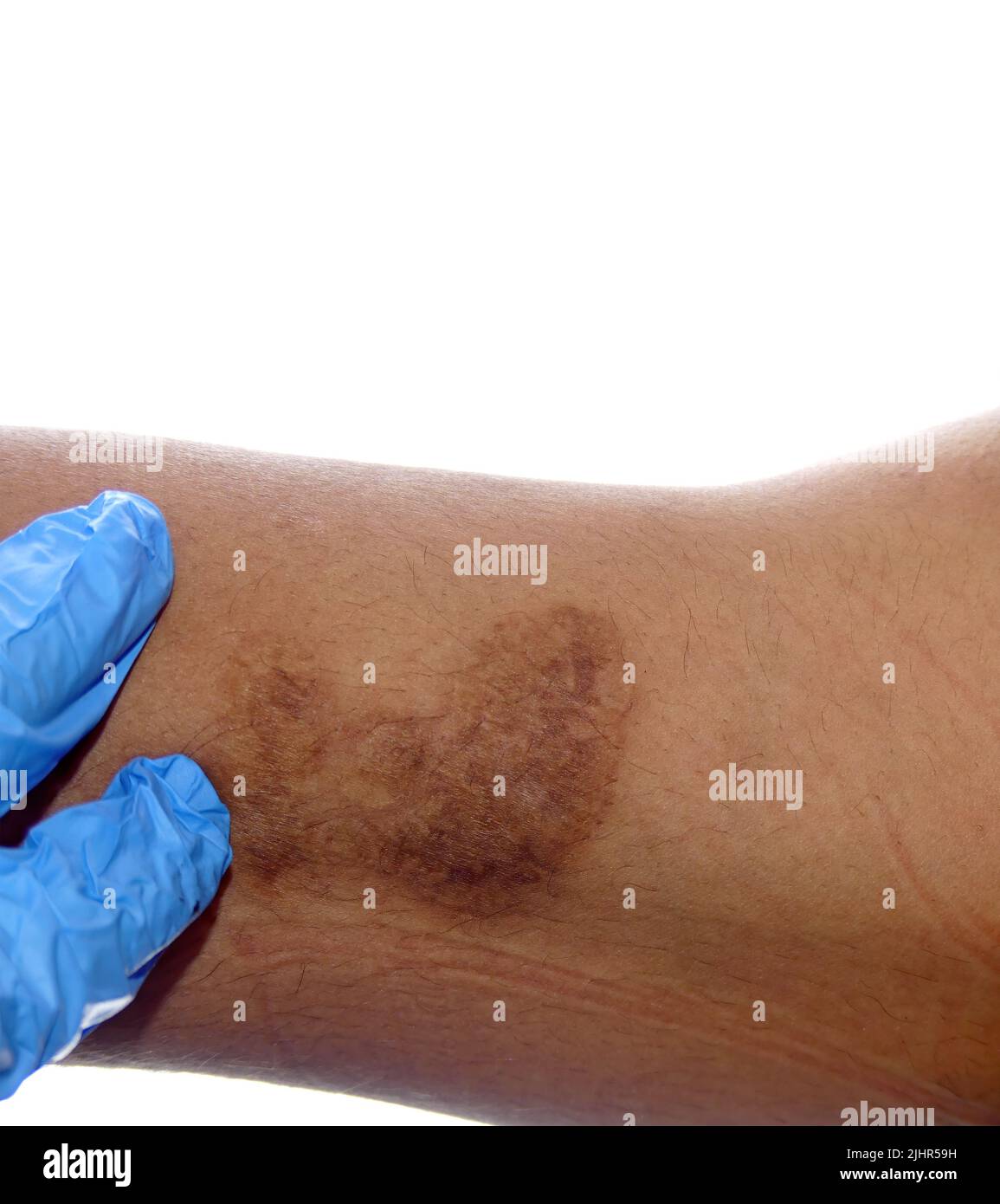 Showing a burn caused by a hot iron during domestic ironing on a white