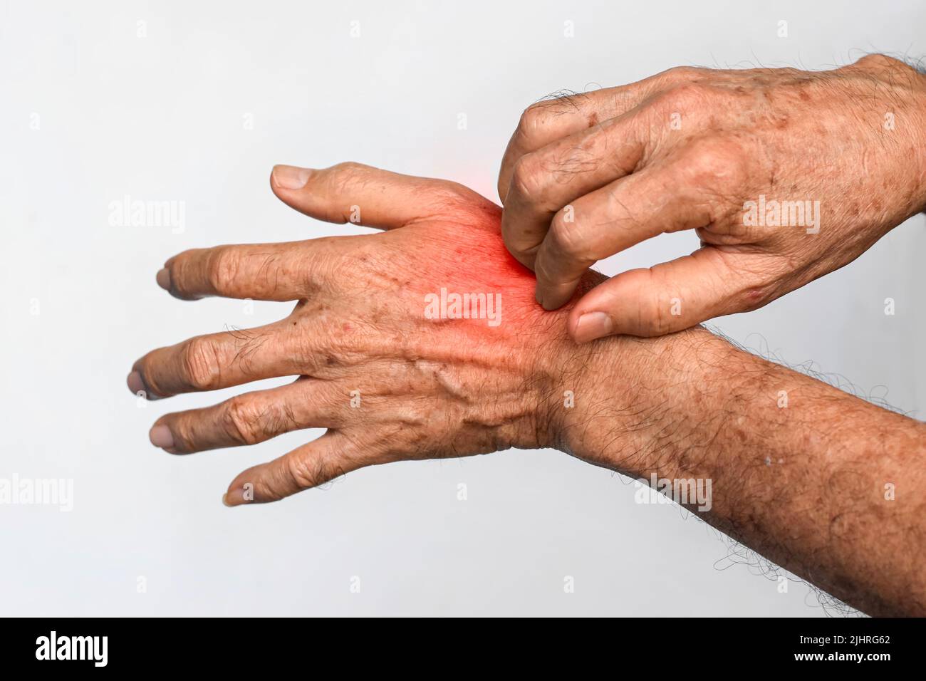 Asian elder man scratching his hand. Concept of itchy skin diseases such as scabies, fungal infection, eczema, psoriasis, allergy, etc. Stock Photo