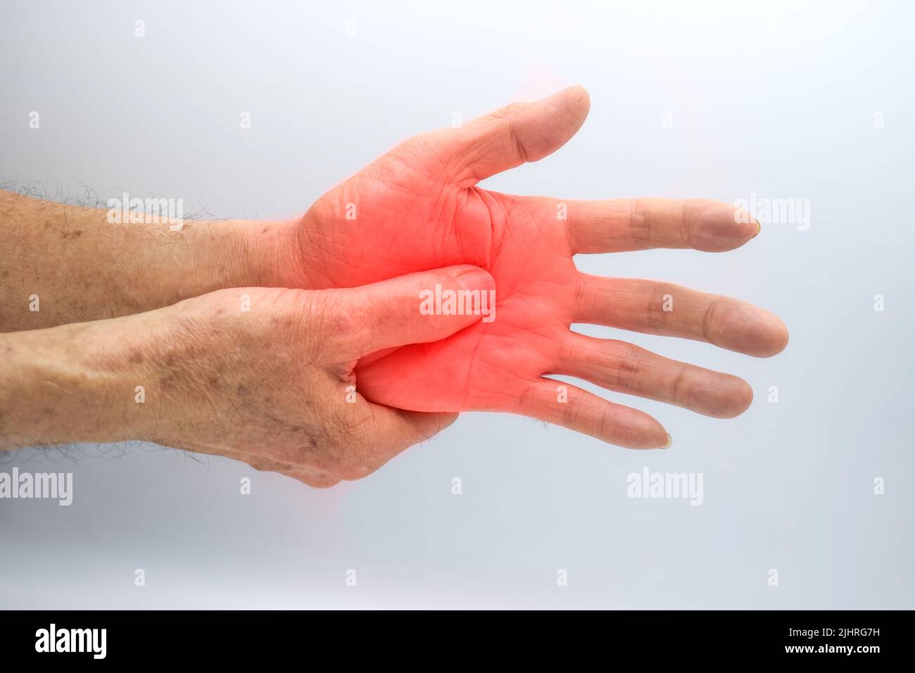 Painful palmar aspect of Asian old man. Concept of compartment syndrome, cellulitis and hand muscles pain. Stock Photo