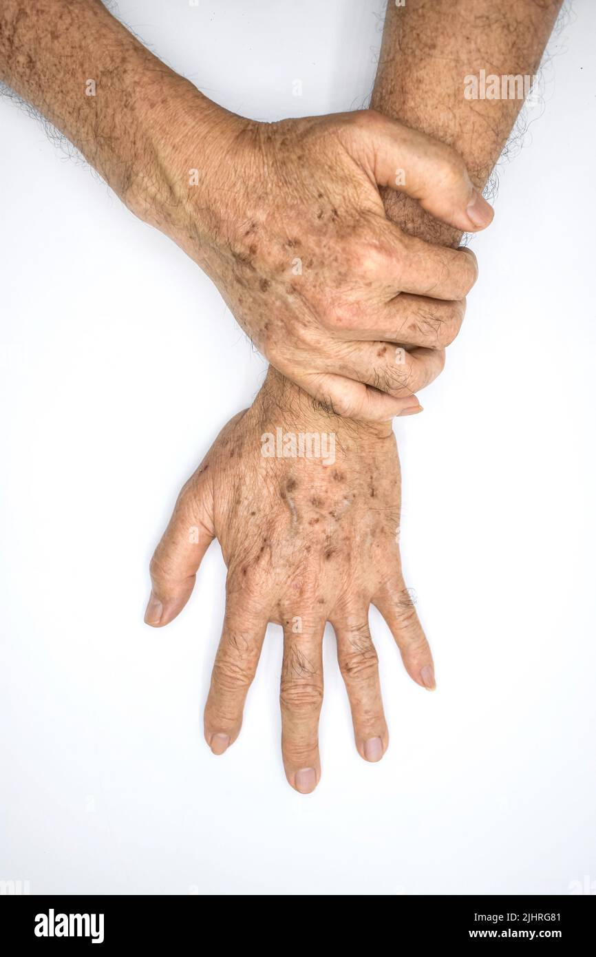Age spots on hands of Asian elder man. They are brown, gray, or black spots and also called liver spots, senile lentigo, solar lentigines, or sun spot Stock Photo