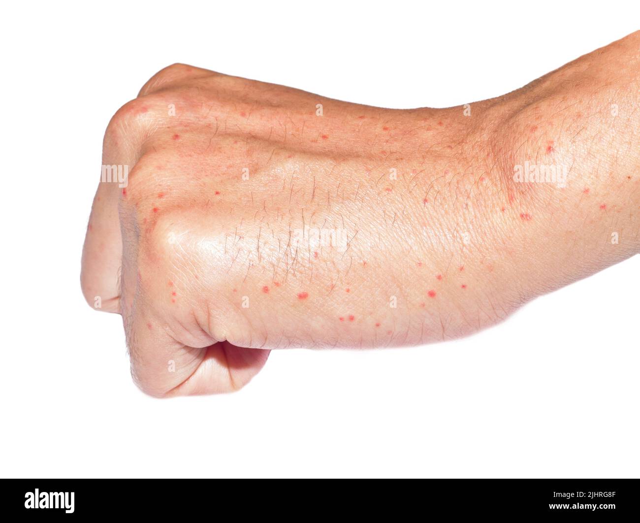 Multiple itchy mosquito or insect bite wheals; red spots on hand of Southeast Asian, Chinese adult young man. Isolated on white background. Stock Photo
