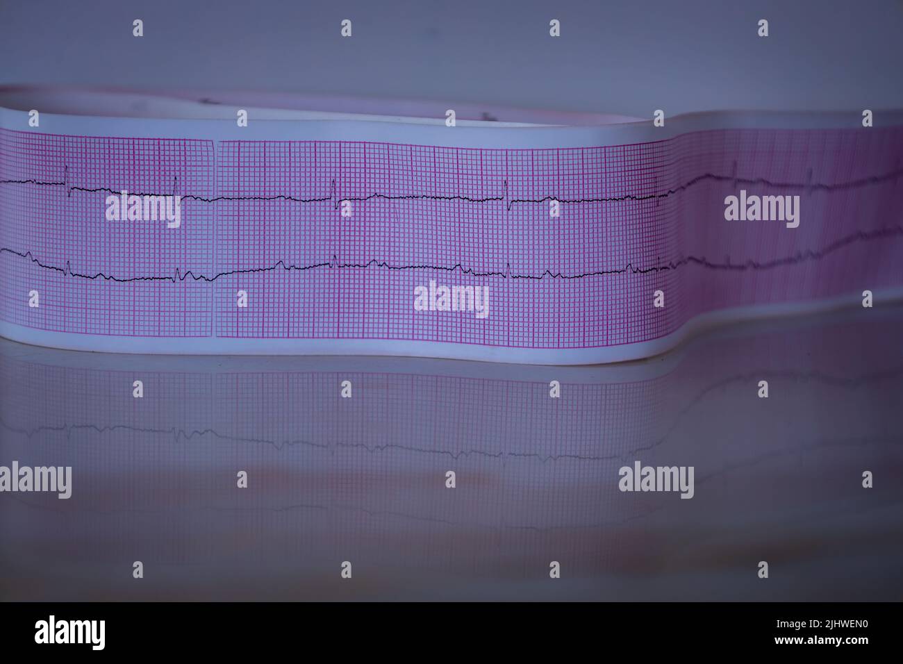 Electrocardiogram of a patient with thirddegree heart block