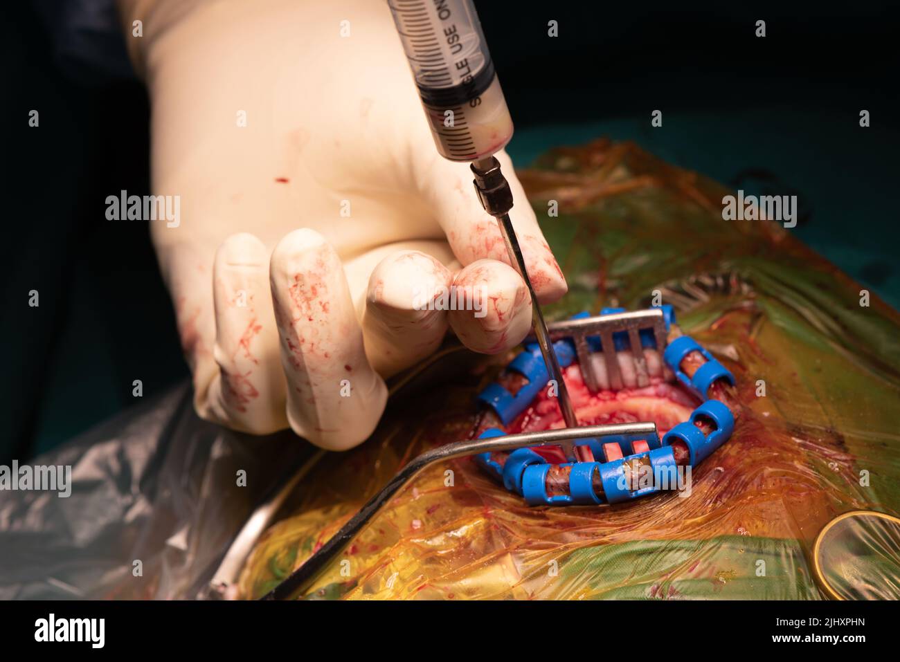Neurosurgeon using syringe aspirate pus from brain abscess in operating room. Stock Photo