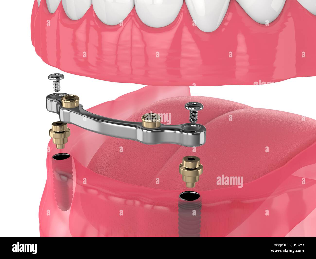 3d render of bar retained removable overdenture installation supported by two implants Stock