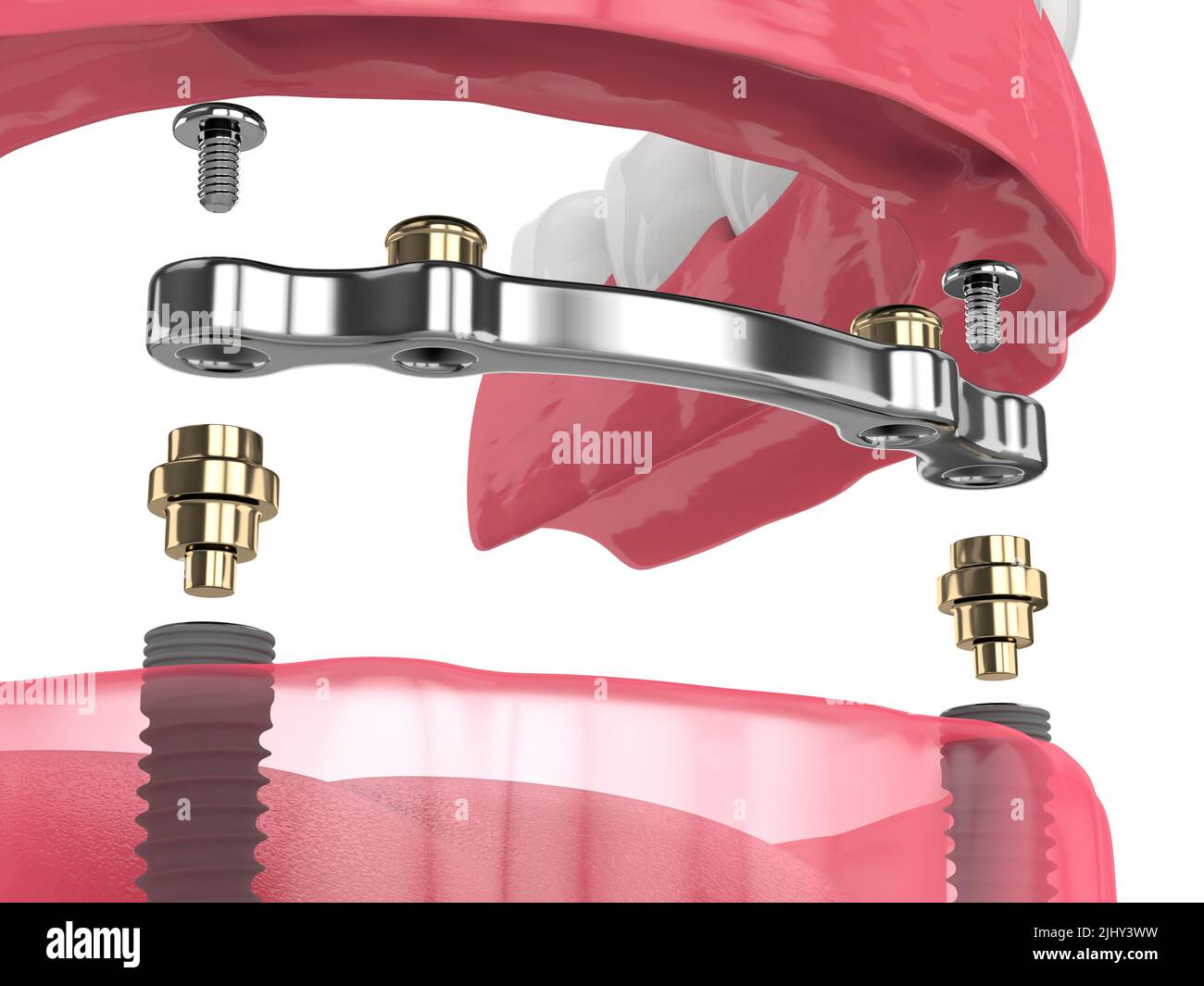 3d render of bar retained removable overdenture installation supported by two implants Stock