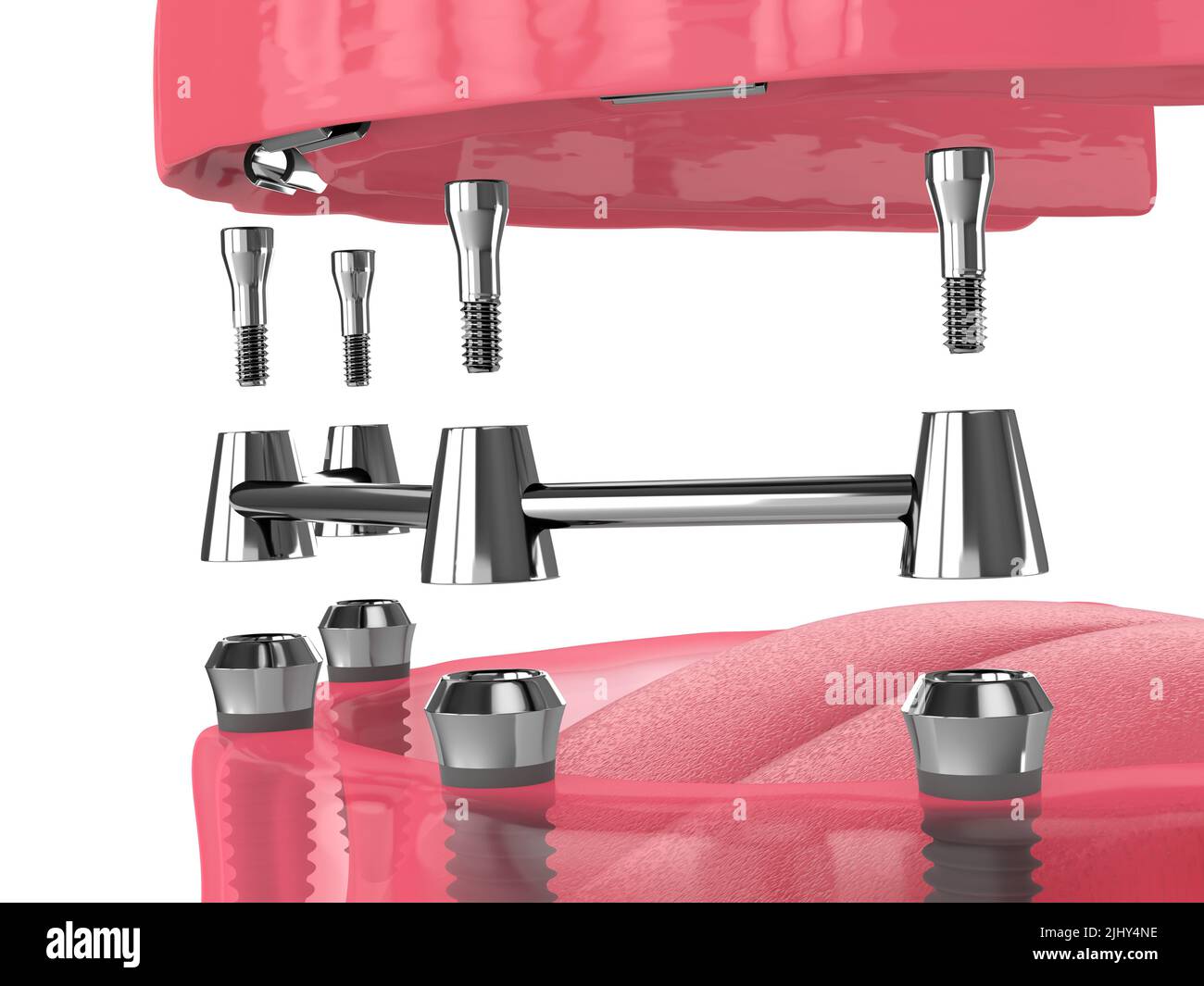 Removable overdenture installation on bar clip attachment, supported by